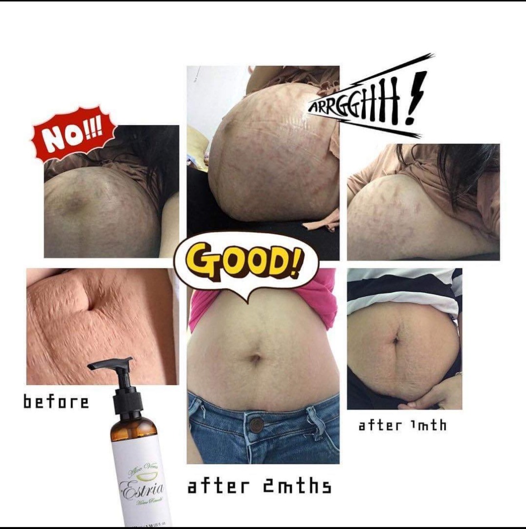 Estria Oil Stretch Mark