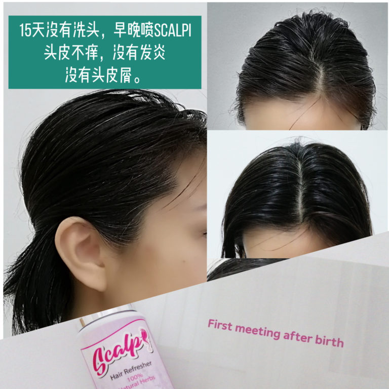 SCALPI 15天没洗头 头皮不痒