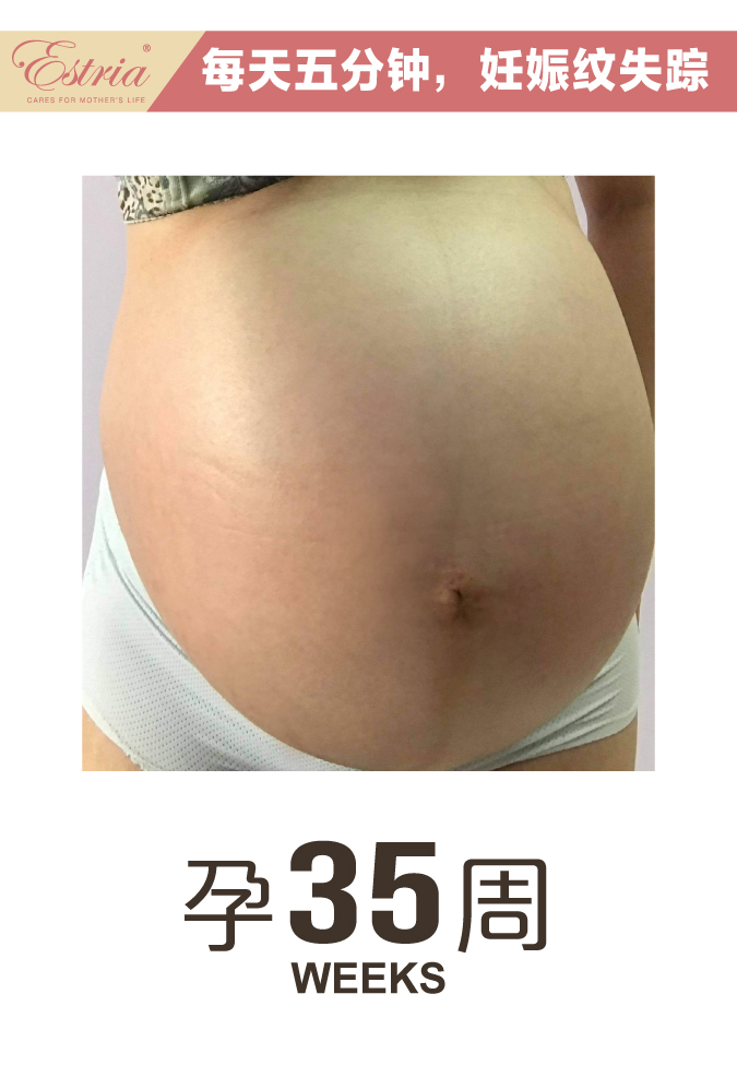 Estria pregnancy journey