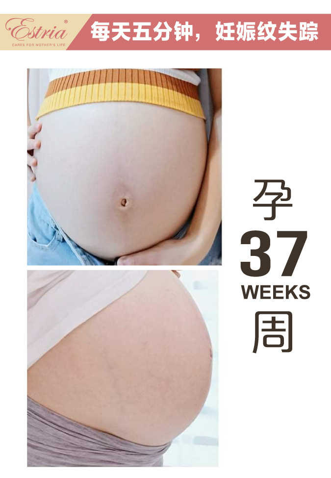 Estria pregnancy journey