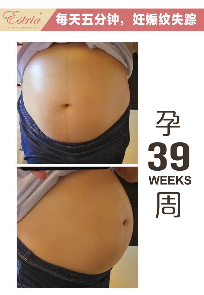 Estria pregnancy journey